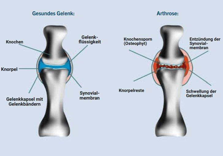Vergleich zwischen einem Knochen mit Arthrose und einem gesunden Knochen